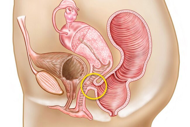 A fistula may allow stool or gas to have access to the bladder, which may cause odor.