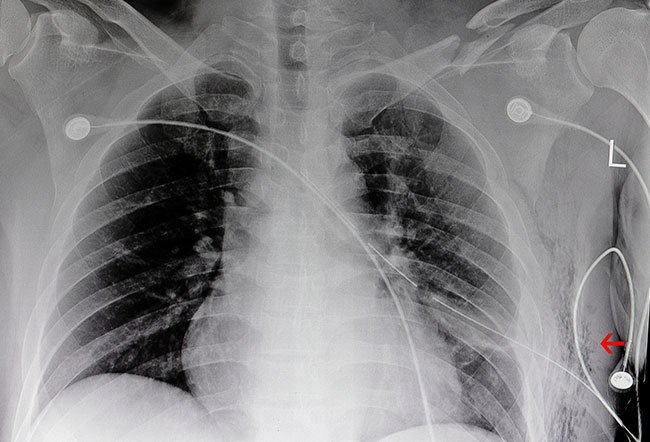 Thoracentesis is usually considered a minimally invasive surgery