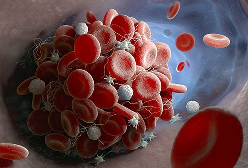 Thrombosis and embolisms are blockages in the blood vessels that require immediate medical treatment. A thrombus occurs in the legs, pelvis, arms or heart while an embolism occurs in the lungs. 