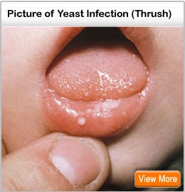 Picture of thrush