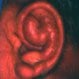 Cauliflower Ear