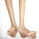 Charcot-Marie-Tooth Disease (CMT)