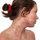 Atopic Dermatitis