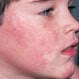 Fifth Disease (Parvovirus, Erythema Infectiosum)