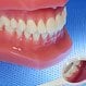 Gum Disease (Gingivitis)