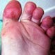 Hand, Foot, and Mouth Disease