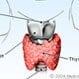 Hashimoto's Thyroiditis