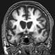 Huntington Disease