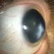 Keratoconus