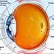 Macular Degeneration