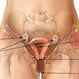 Pelvic Inflammatory Disease (PID)