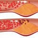 Peripheral Vascular Disease