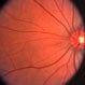 Retinal Detachment