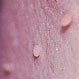 Skin Tag Removal