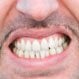 Teeth Grinding (Bruxism)