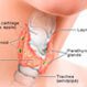 Thyroid Nodules