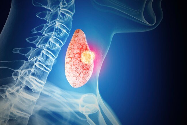 The first sign is often a small bump, or "nodule," on your thyroid gland.