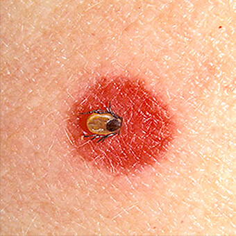 Ticks feed on blood and can bite humans or animals.
