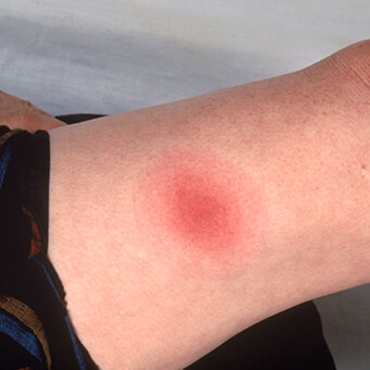 The red rings of a target rash could indicate Lyme disease.
