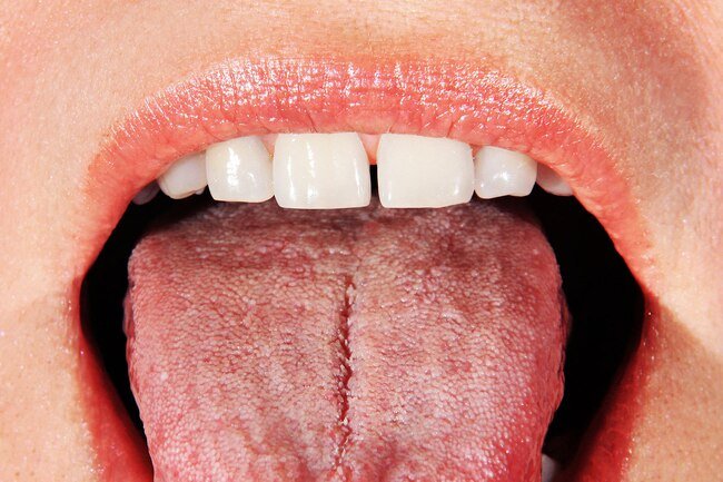 Dry mouth and Sjögren's syndrome may cause dry mouth.