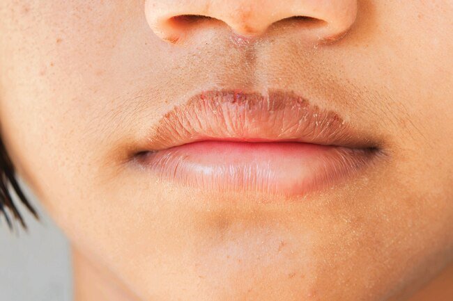 Cold weather, cosmetics, medications, and dehydration may all contribute to chapped lips.