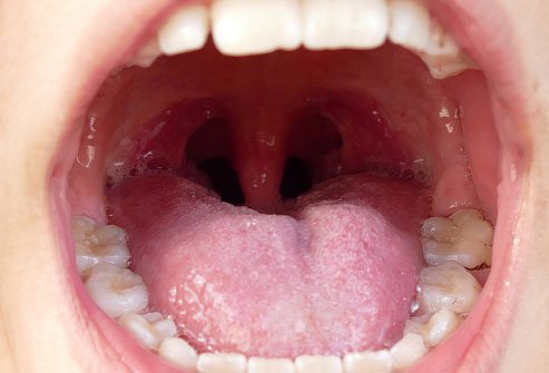 Tonsil stones can form when food, mucus, and bacteria get stuck in craters of the tonsils.