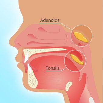 TextTonsillectomy and adenoidectomy surgery can improve sleep.