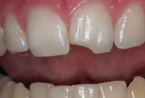 More than 75% of these chipped teeth are molars, the back teeth that grind down your food.