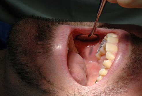 That blue-gray spot in the soft tissue of your mouth is probably not a tattoo—but it could look a lot like one.