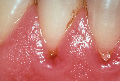 When periodontal (gum) disease develops, bacteria in plaque accumulate along the gum line.