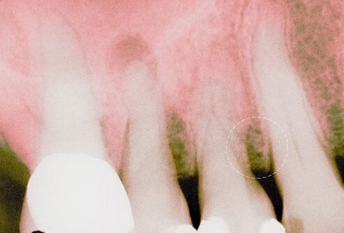 After gingivitis, gum disease can develop into its second stage—periodontitis.