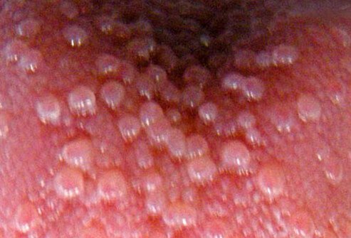 According to an old wives' tale, telling a lie causes a bump on the tongue.