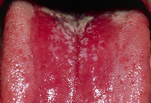 Oral Thrush