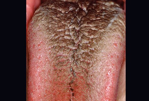 Black hairy tongue occurs when the tiny bumps on your tongue seem increase in size, trapping bacteria.