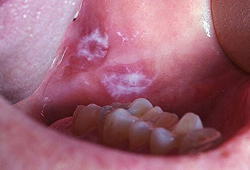 If you see painless, white patches in your mouth that can't be scraped away, you may have leukoplakia.