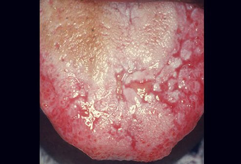 If you see white, lacy patches or shiny, red bumps on your tongue or cheeks, you may have lichen planus.
