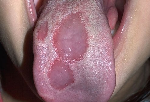 he depressions lack the usual tongue bumps, and can shift in size, area, and pattern within minutes.