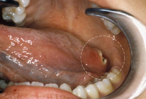 Oral cancer