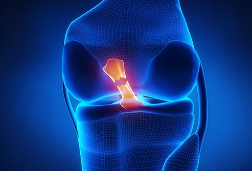 Illustration of a torn ACL