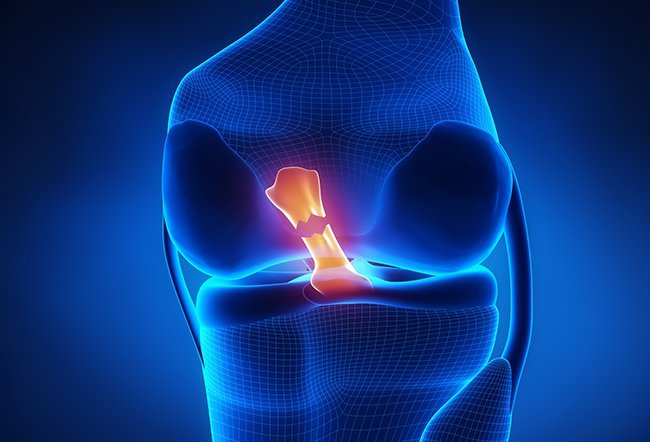 is it worse to tear a ligament or a tendon