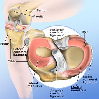 Illustration of a torn meniscus.