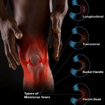 Joint overlay of a man's knee and types of meniscus tears.