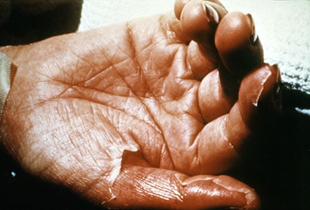Picture of skin loss in toxic shock syndrome (TSS)