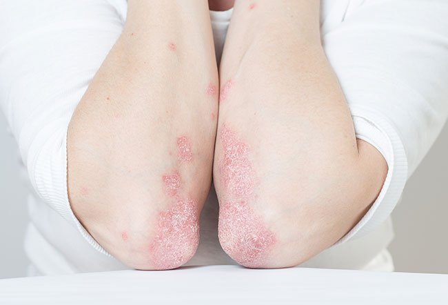 Psoriatic arthritis diagnosis