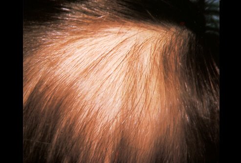 Picture of Trichotillomania