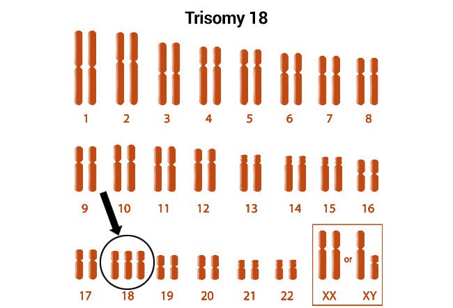 karyotype of trisomy 18