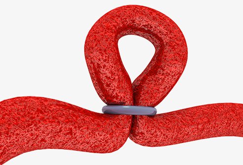 Tubal ligation or tying tubes is a permanent birth control surgical procedure