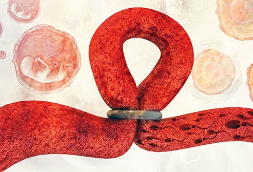 Tubal sterilization may be reversible, depending on how the original procedure was done. 