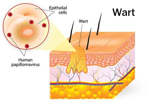 Warts are noncancerous skin growths that are often flesh-colored and contagious.