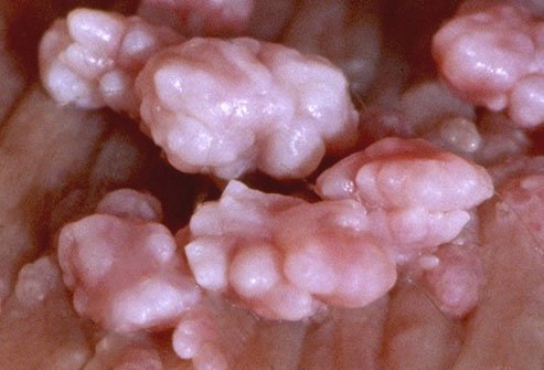 Some HPV types cause genital warts and increase the risk of cervical cancer.